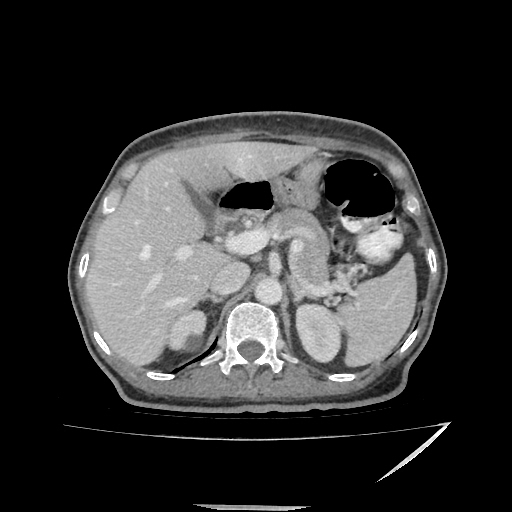 Anorectal carcinoma (Radiopaedia 44413-48064 A 14).jpg