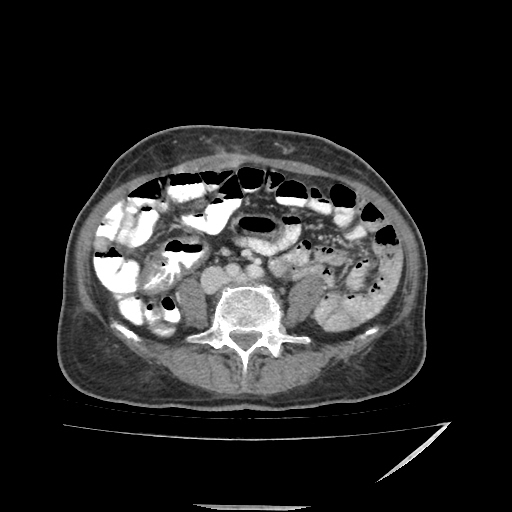 Anorectal carcinoma (Radiopaedia 44413-48064 A 34).jpg