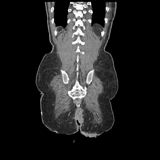 Anorectal carcinoma (Radiopaedia 44413-48064 B 80).jpg