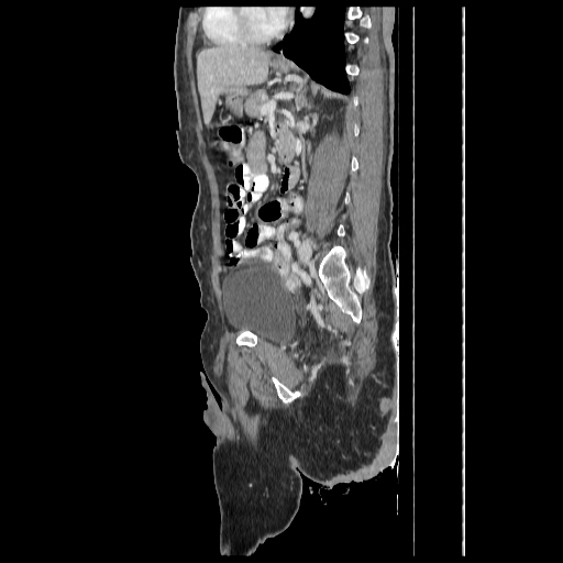 Anorectal carcinoma (Radiopaedia 44413-48064 C 66).jpg