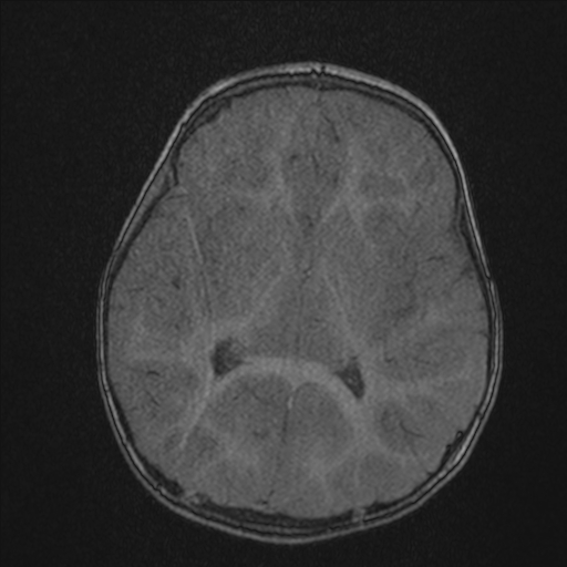 Anoxic brain injury (Radiopaedia 79165-92139 Axial MRA 128).jpg