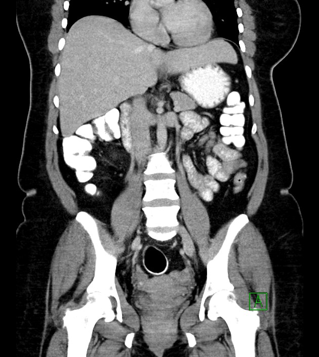 Anterior abdominal wall CSF pseudocyst (CSFoma) (Radiopaedia 79453-92571 B 31).jpg