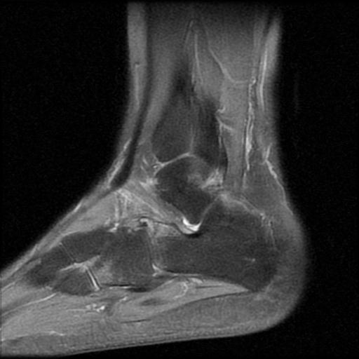 File:Anterior calcaneal process fracture (Radiopaedia 71377-81705 Sagittal PD fat sat 5).jpg