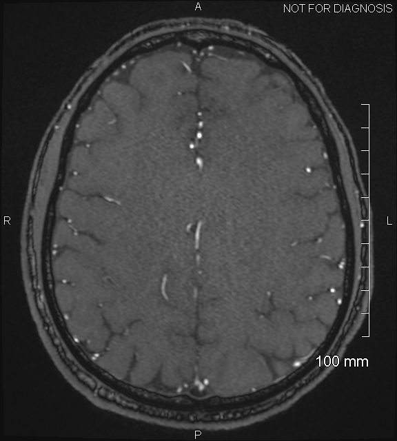 Anterior cerebral artery aneurysm (Radiopaedia 80683-94127 Axial MRA 173).jpg