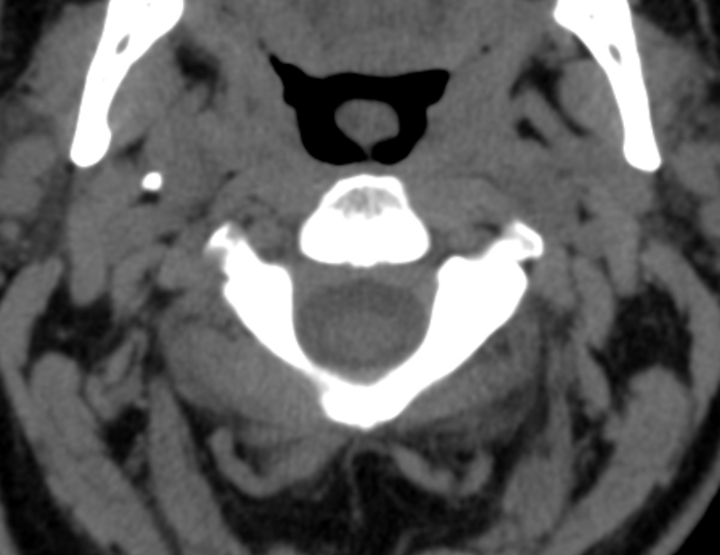 Anterior cervical postdiscectomy arthrodesis (Radiopaedia 32678-33646 Axial non-contrast 21).jpg