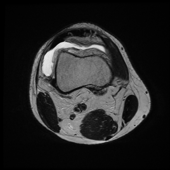 File:Anterior cruciate ligament graft tear and bucket-handle tear of medial meniscus (Radiopaedia 75867-87255 Axial T2 21).jpg