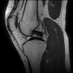 File:Anterior cruciate ligament rupture and posteromedial corner injury (Radiopaedia 67338-76723 Sagittal PD 75).jpg