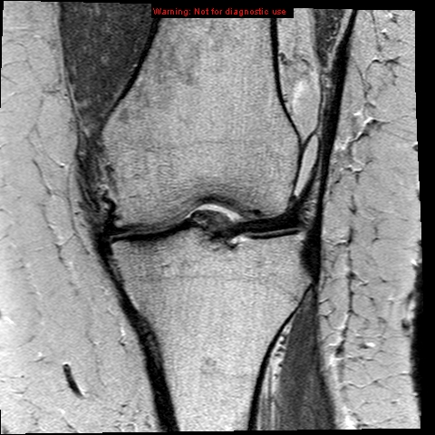 File:Anterior cruciate ligament tear (Radiopaedia 12329-12612 Coronal PD 8).jpg