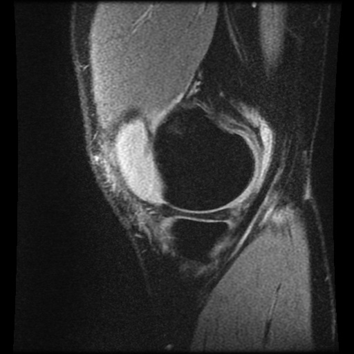 Anterior cruciate ligament tear (Radiopaedia 61500-69462 F 10).jpg