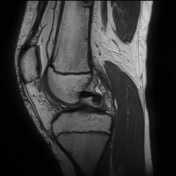 Anterior cruciate ligament tear - pediatric (Radiopaedia 62152-70260 Sagittal PD 75).jpg