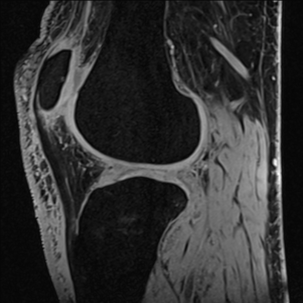 Anterior cruciate ligament tear - ramp lesion (Radiopaedia 71883-82322 Sagittal T1 vibe 53).jpg