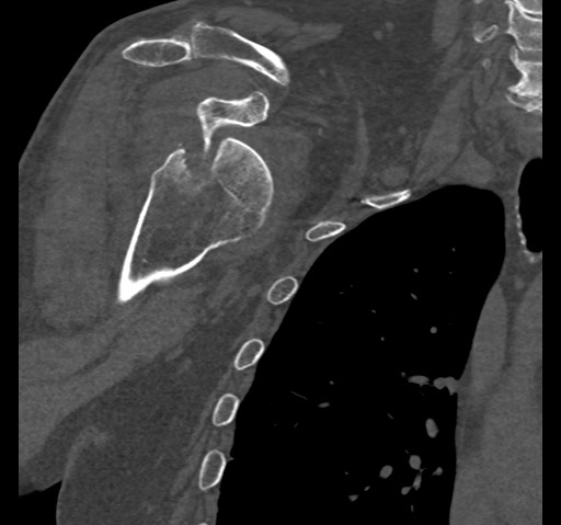 Anterior glenohumeral dislocation with Hill-Sachs lesion (Radiopaedia 62877-71249 Coronal bone window 38).jpg
