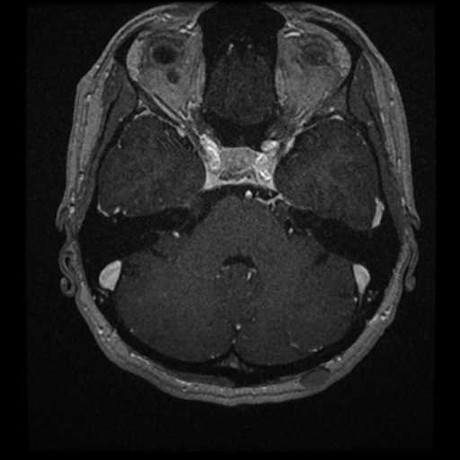Anterior inferior cerebellar artery vascular loop - type II (Radiopaedia 70991-81209 Axial T1 C+ 33).jpg