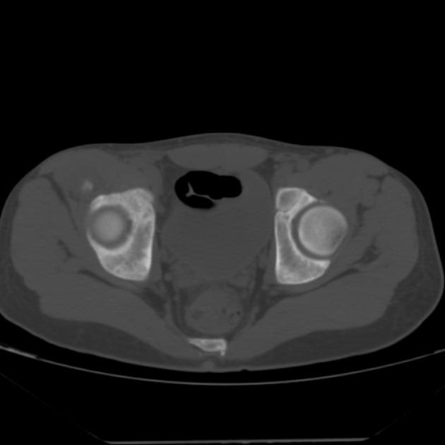 Anterior inferior iliac spine avulsion fracture (Radiopaedia 49469-54627 Axial bone window 36).jpg