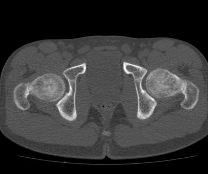 Anterior inferior iliac spine avulsion fracture (Radiopaedia 81312-94999 Axial bone window 59).jpg