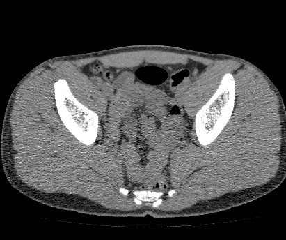 File:Anterior inferior iliac spine avulsion fracture (Radiopaedia 81312-94999 Axial non-contrast 43).jpg