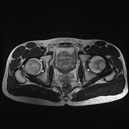File:Anterior inferior iliac spine avulsion fracture (Radiopaedia 81312-95000 Axial T2 15).jpg