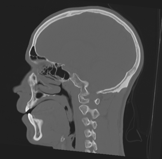 Anterior nasal spine fracture (Radiopaedia 46138-50494 Sagittal bone window 33).png
