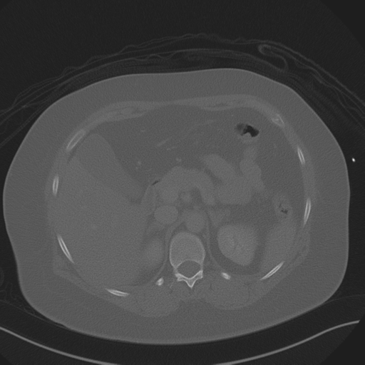 File:Anterior superior iliac spine avulsion fracture (Radiopaedia 44541-48244 Axial bone window 29).png