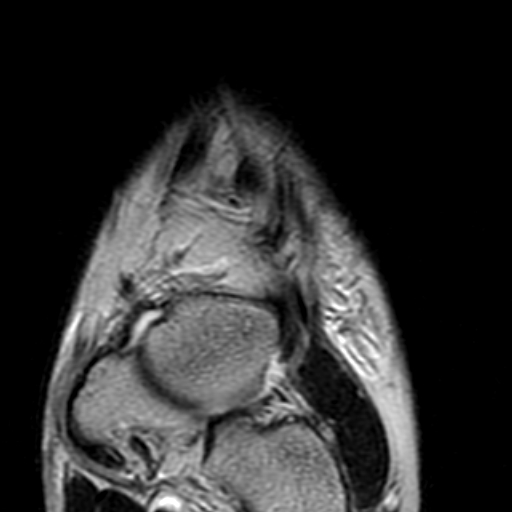 File:Anterior talofibular ligament rupture (Radiopaedia 15831-15484 Coronal T2 3).jpg