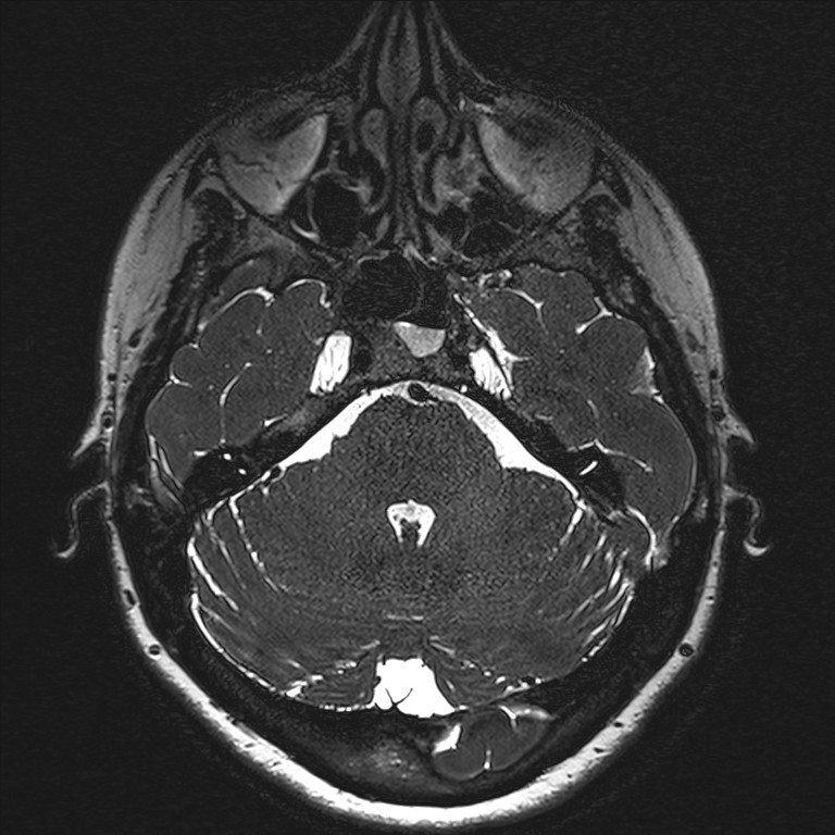 Anterior temporal encephalocele (Radiopaedia 82624-96808 Axial T2 high res 32).jpg