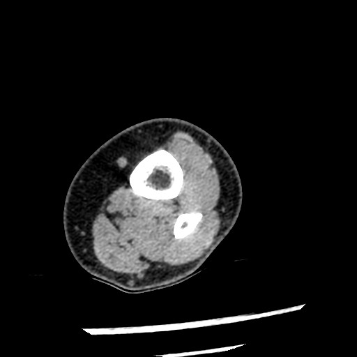 File:Anterior tibial artery false aneurysm (Radiopaedia 88984-105809 A 12).jpg