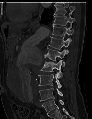 File:Anterior vertebral scalloping (abdominal aortic aneurysm) (Radiopaedia 66744-76067 Sagittal bone window 50).jpg