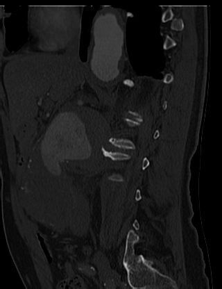 File:Anterior vertebral scalloping (abdominal aortic aneurysm) (Radiopaedia 66744-76067 Sagittal bone window 6).jpg