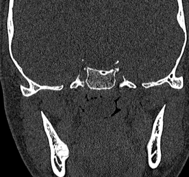 File:Antrochoanal polyp (Radiopaedia 30002-30554 Coronal bone window 73).jpg