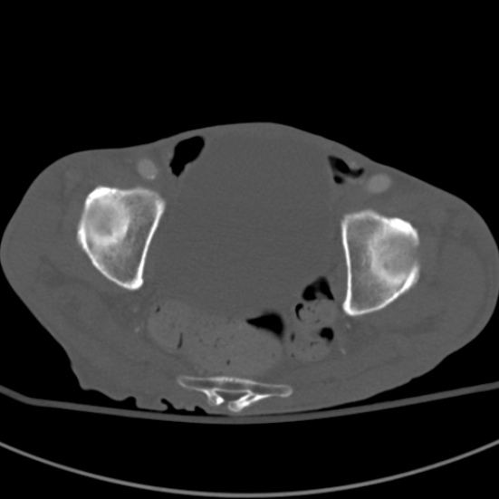 Aortic aneurysm with spinal destruction (Radiopaedia 42301-45410 Axial bone window 99).jpg