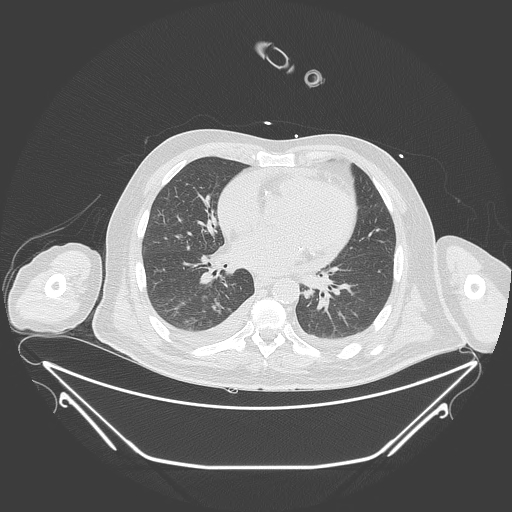 Aortic arch aneurysm (Radiopaedia 84109-99365 Axial lung window 169).jpg