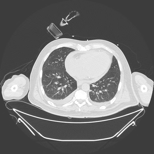 Aortic arch aneurysm (Radiopaedia 84109-99365 Axial lung window 189).jpg