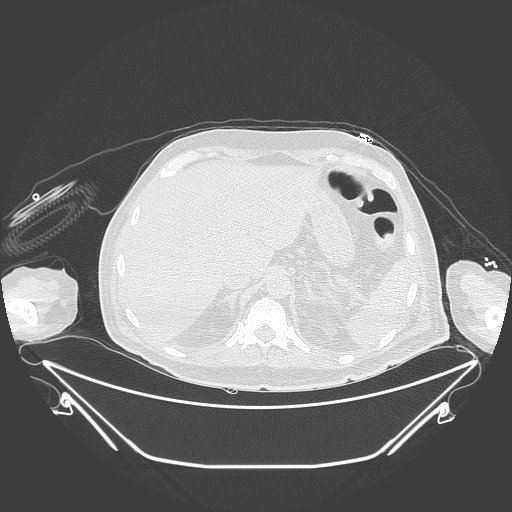Aortic arch aneurysm (Radiopaedia 84109-99365 Axial lung window 260).jpg
