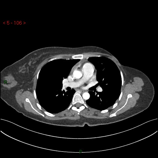 File:Aortic arch origin of left vertebral artery (Radiopaedia 51520-57286 A 105).jpg