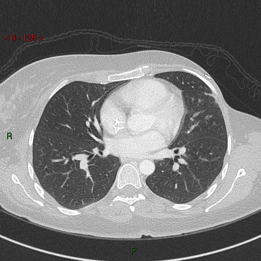 Aortic arch origin of left vertebral artery (Radiopaedia 51520-57286 Axial lung window 125).jpg