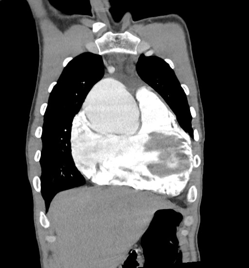 Aortic coarctation with aneurysm (Radiopaedia 74818-85828 C 27).jpg