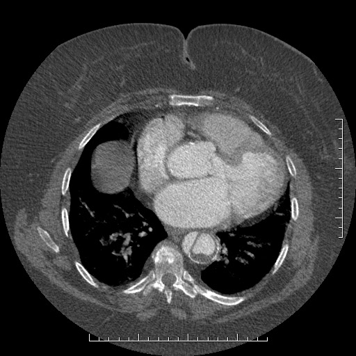 Aortic dissection- Stanford A (Radiopaedia 35729-37268 A 61).jpg