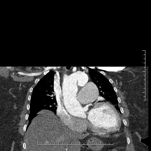Aortic dissection- Stanford A (Radiopaedia 35729-37268 E 40).jpg