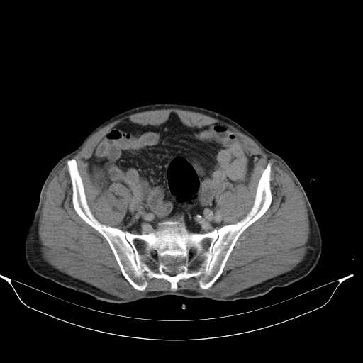 File:Aortic dissection- Stanford type A (Radiopaedia 22085-22085 Axial C+ delayed 42).jpg