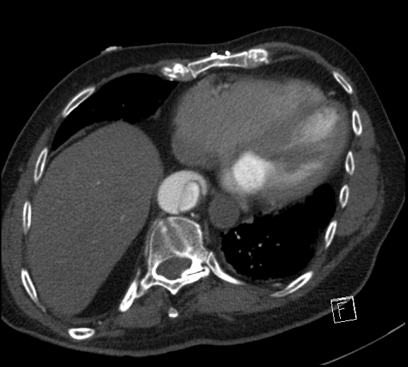 Aortic dissection (CTPA) (Radiopaedia 75506-86750 A 70).jpg