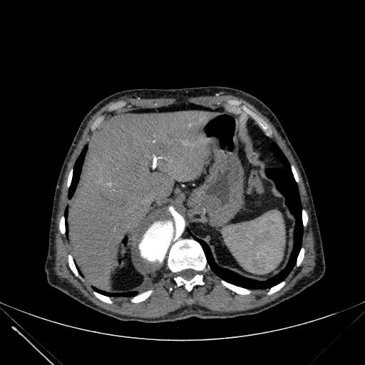Aortic dissection (Radiopaedia 27466-27665 C+ arterial phase 262).jpg