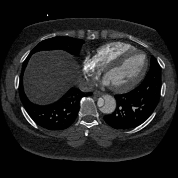 Aortic dissection (Radiopaedia 57969-64959 A 215).jpg