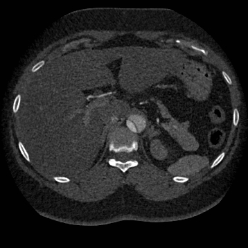 Aortic dissection (Radiopaedia 57969-64959 A 317).jpg