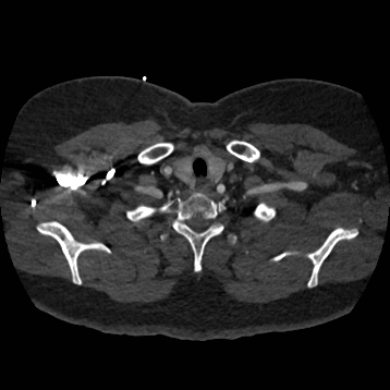 Aortic dissection (Radiopaedia 57969-64959 A 32).jpg