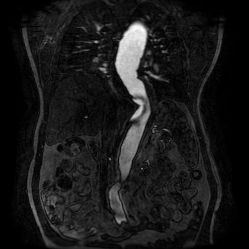Aortic dissection - Stanford A - DeBakey I (Radiopaedia 23469-23551 D 139).jpg