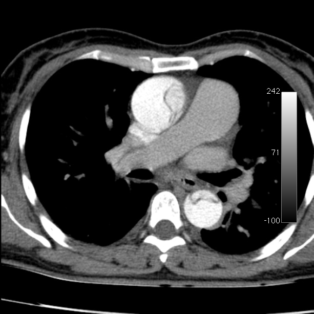 Aortic dissection - Stanford type A (Radiopaedia 29247-29659 A 36).jpg