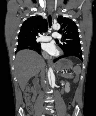 File:Aortic dissection - Stanford type B (Radiopaedia 73648-84437 B 62).jpg