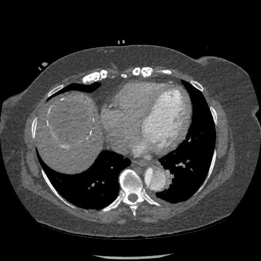 Aortic dissection - Stanford type B (Radiopaedia 88281-104910 A 64).jpg