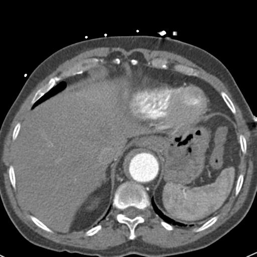 Aortic intramural hematoma (Radiopaedia 31139-31838 B 74).jpg