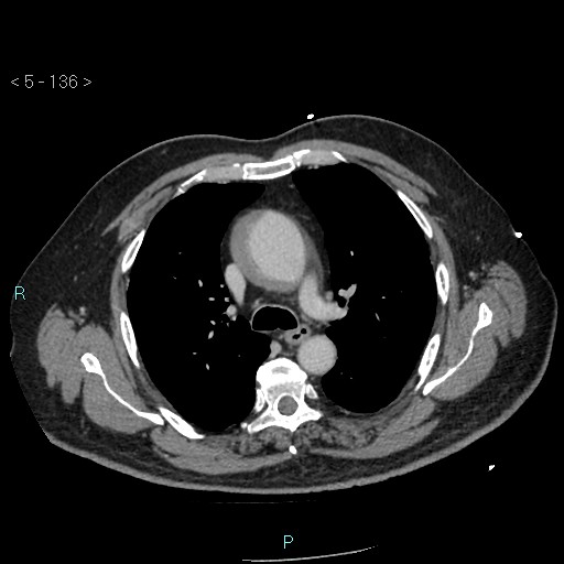 File:Aortic intramural hematoma (Radiopaedia 48463-53380 C 62).jpg
